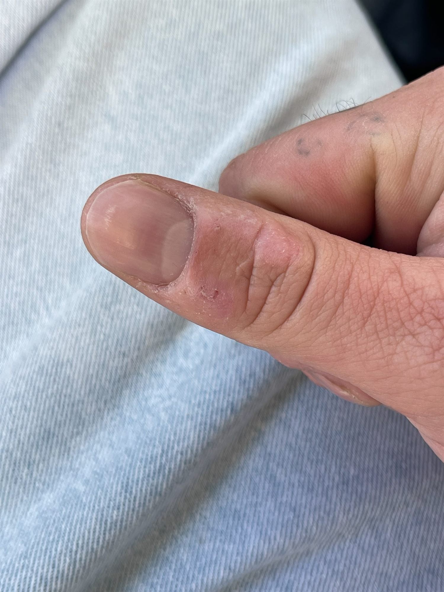 Close view of a thumb and the cuticle beside the nail